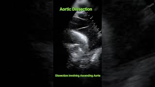 Aortic dissection [upl. by Aiym]