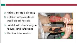 Calciphylaxis  Wound Care Topics  Free Wound Care Info  WoundEducatorscom [upl. by Etyam]