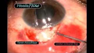 New glaucoma injectable implant Healaflow in Trabeculectomy surgery [upl. by Allerie]