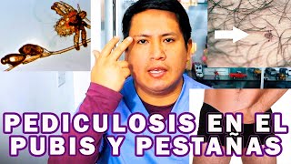 COMO ELIMINAR LA PEDICULOSIS EN EL PUBIS Y PESTAÑAS [upl. by Enej]