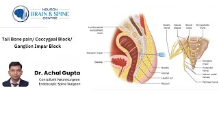 Tail bone pain Coccygeal block Ganglion Impar block  Dr Achal Gupta  Neuro amp Spine Surgeon [upl. by Ailisab]