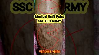 Medical Unfit PointSSC GDCRPF Recruitment shorts sscgd bsf crpf [upl. by Garlen]