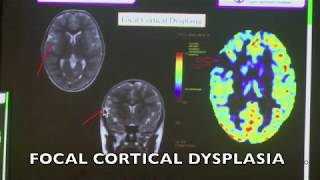 TMT ARTERIAL SPIN LABELING IN NEURORADIOLOGY [upl. by Vernor]