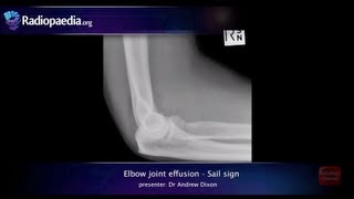 Elbow joint effusion and the sail sign  radiology video tutorial xray [upl. by Ahserb]