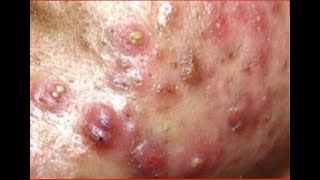 Part 06  Acne Vulgaris and Extracting large Whiteheads [upl. by Garett]