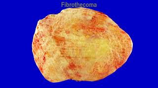 Solid ovarian tumors 22  Fibroma amp Thecoma [upl. by Tiff381]