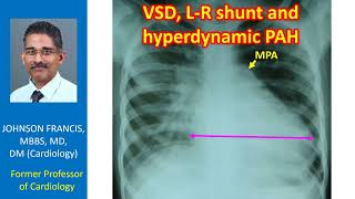 VSD LR shunt and hyperdynamic PAH [upl. by Zzahc]