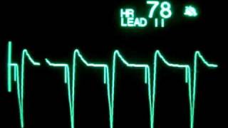 Ventricular Pacing [upl. by Bonnee]