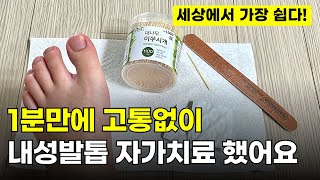 이렇게 하면 내성발톱 바로 치료됩니다 ㅣ 집에서 0원으로 내성발톱 셀프 교정 [upl. by Ennayram277]