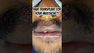 A Mustache Transplant🤯😨😫  How to Fix a Patchy Mustache [upl. by Chilt116]