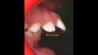 Amazing two phase treatment of Sever Class II Div 1  lama 10Y [upl. by Cristiano105]