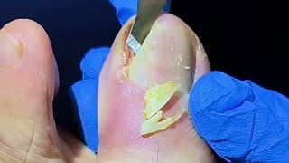 Big Hole on Big Toe After Huge Ingrown Toenail Removal [upl. by Lal]