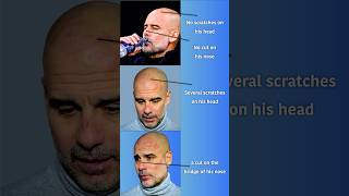 Pep Guardiola Cuts amp Bruises in Man City vs Feyenoord Champions League Game [upl. by Assenev]