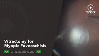 Orbit tips 046  Vitrectomy for Myopic Foveoschisis [upl. by Moody]