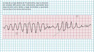 Torsades de pointes  Clases EKG 44 [upl. by Yrocej]