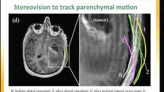 Integration of 3D intraoperative ultrasound for enhanced neuronavigation [upl. by Ecinev]