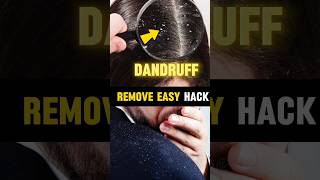 🔥Dandruff Remove Hacks 😱  mens fashion tips banglashortsshortsfeedmensfashion [upl. by Conover]