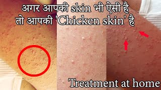 Chicken skin treatment  Alarge body solution in hindi\katha brana treatment \ keratosis pilaris [upl. by Wilber]