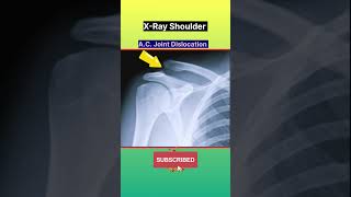 AC Joint Dislocation  XRay Shoulder shorts xray radiology fracture [upl. by Haman]