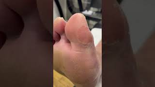 Watch a Podiatrist Remove Hard Skin and Calluses from Big Toe  Dry Cracked Skin Treatment [upl. by Trinatte]