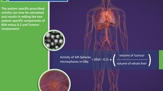 Dosimetry for SIRSpheres Y90 resin microspheres [upl. by Solokin704]