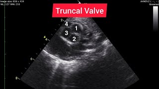 Truncus Arteriosus Echocardiography Compilation [upl. by Milford]