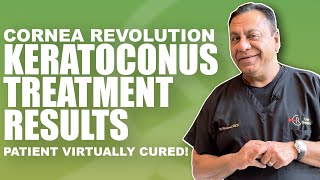 Cure for Keratoconus with Crosslinking and CREATE Protocol No more cone [upl. by Niboc]