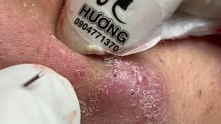 Make your Acne Treatment Huong Da Nang  479 acne 2022 [upl. by Aziaf796]