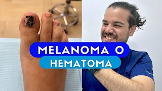 ¿Melanoma subungueal Caso interesante [upl. by Halden]