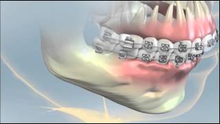 Orthognathic Surgery NYC [upl. by Howie]