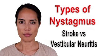 Types of Nystagmus Due to Stroke vs Vestibular Neuritis Causing Persistent Dizziness or Vertigo [upl. by Nastassia]