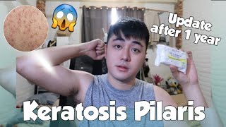 UPDATE SA KERATOSIS PILARIS KO  chicken skin  AFTER 1 YEAR 😳😥 [upl. by Vernon283]