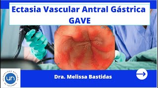 Ectasia Vascular Antral Gastrica GAVEDra Melissa Bastidas [upl. by Soren]