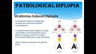 Diplopia basics types of diplopia optometry eyecare ophthalmology optics vision subscribe [upl. by Rem148]