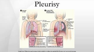 Pleurisy [upl. by Ymiaj]