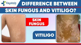 Tinea versicolor Fungal Infection vs Vitiligo Safed daag ka ilaaj  Kayakalp Global [upl. by Shell]