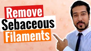 Sebaceous Filaments  3 Steps to Get Rid of Sebaceous Filaments FAST [upl. by Lathrope]