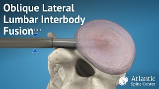 Oblique Lateral Lumbar Interbody Fusion [upl. by Sheppard]