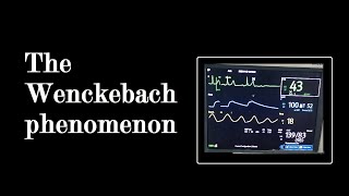 Second degree Heart Block  Mobitz type 1  Wanckebach Phenomenon [upl. by Retseh633]