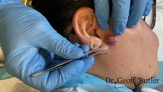 Drainage of an infected cyst in front of the ear [upl. by Aneg]