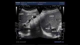 Multiple findings including gall stones single kidney and hepatic Mass [upl. by Bej]