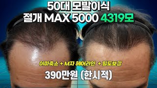 모발이식비용 50대 탈모 M자 모발이식 헤어라인 교정 4319모 이식 390만원한시적 [upl. by Nahtanha44]