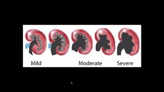 Hydronephrosis  Ultrasound [upl. by Ayal]