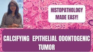 CALCIFYING EPITHELIAL ODONTOGENIC TUMOR  PART2  HISTOPATHOLOGY MADE EASY I ORAL PATHOLOGY [upl. by Ogait]