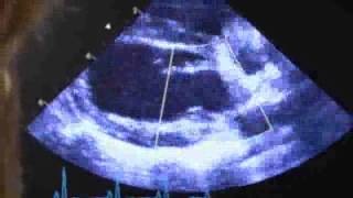 Echocardiography Common views 14  Interest of Echocardiography [upl. by Colvin]