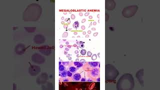 Megaloblastic anemia … draditikumar pathologylaboratory mbbs neet usmleprep usmle [upl. by Weinreb807]