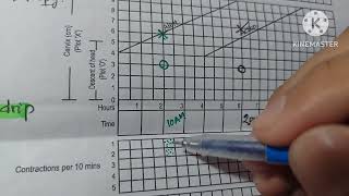 How To Diagnosis Prolonged and Obstructed Labour in Partograph [upl. by Ayhay]