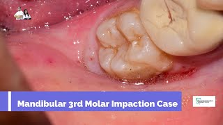 Mandibular 3rd Molar Impaction [upl. by Giacomo98]