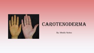 Carotenoderma  orange skin causes and pathophysiology [upl. by Anilev]