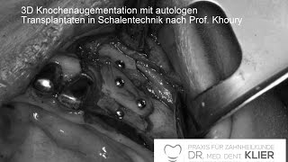 Augmentation Knochenaufbau UK Knochenblock vom Kieferwinkel in Schalentechnik SBB n Prof Khoury [upl. by Gwynne]